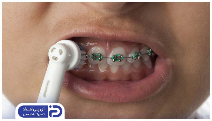 روش استفاده از مسواک برقی به هنگام ارتودنسی